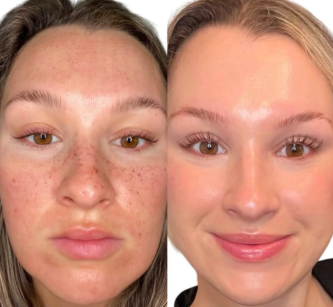 pigment removal paramus nj